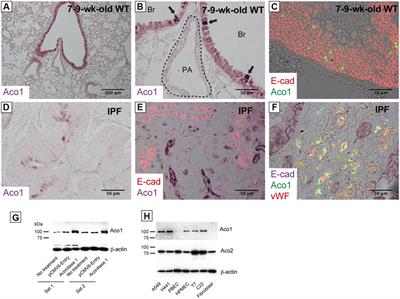 Aberrant Expression of ACO1 in Vasculatures Parallels Progression of Idiopathic Pulmonary Fibrosis